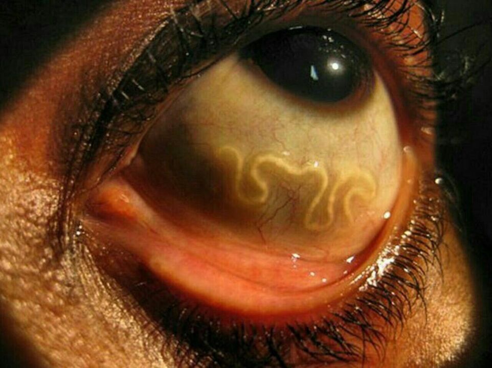 parasitas no olho humano